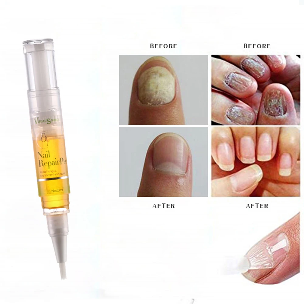 Уход за ногтями ремонт лечение жидкая ручка микоз, Paronychia противогрибковая инфекция ногтей Ноги Уход за ногтями грибковое Лечение ногтей TSLM1