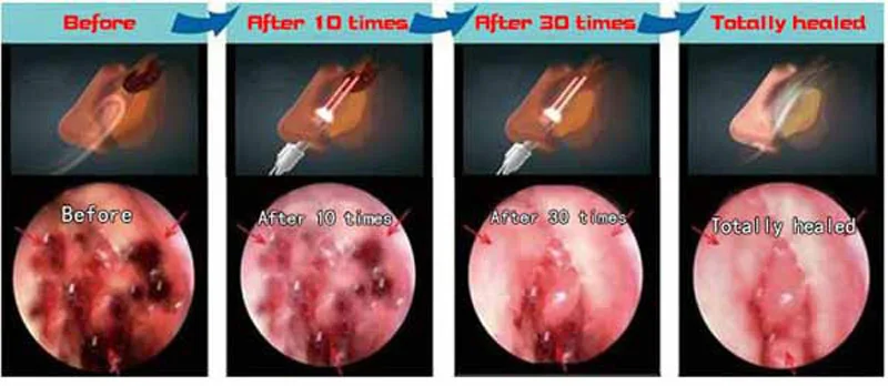 Уход за здоровьем бионаза для носа, для лечения ринитов синусита лечение аллергии и ринита терапия массажное устройство машина Лечение импульсный лазер