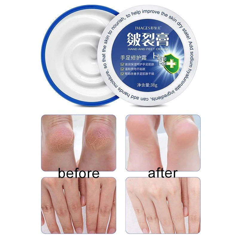 himalaya stretch marks