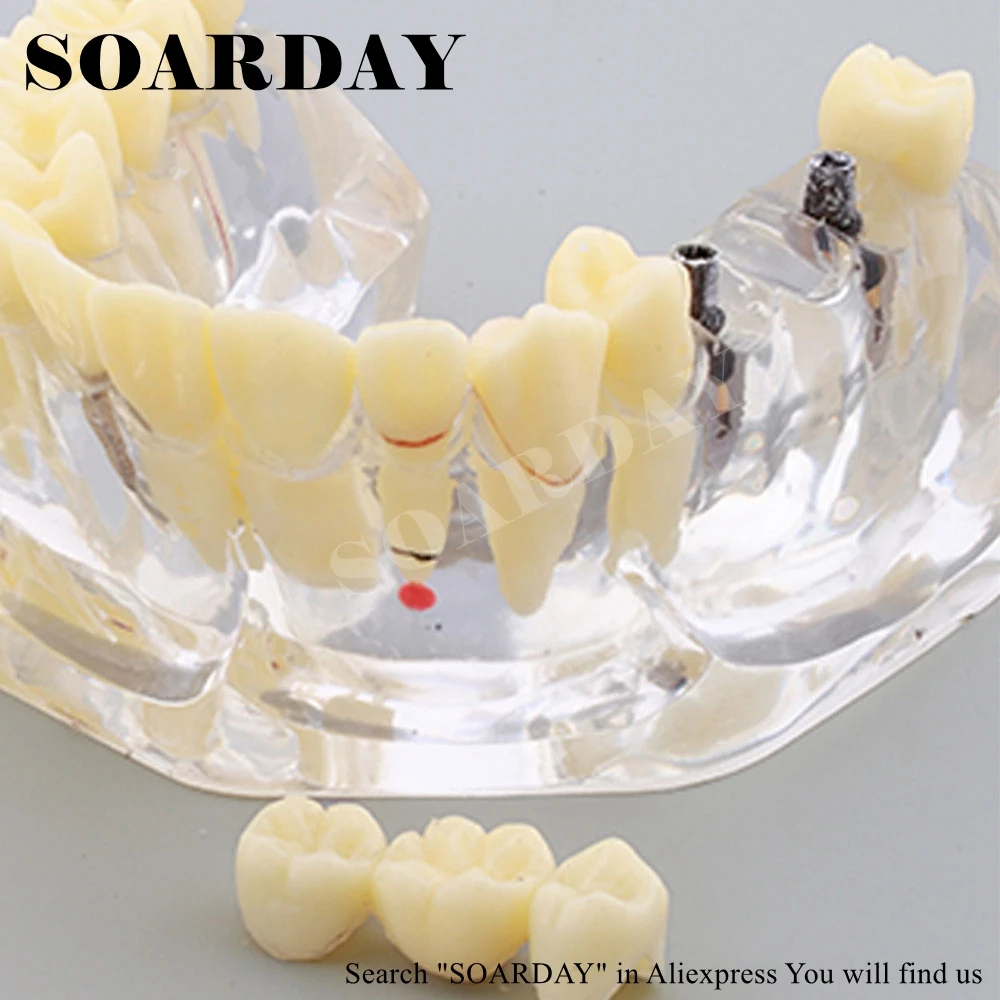 2 times Dental Pathological Model (3)