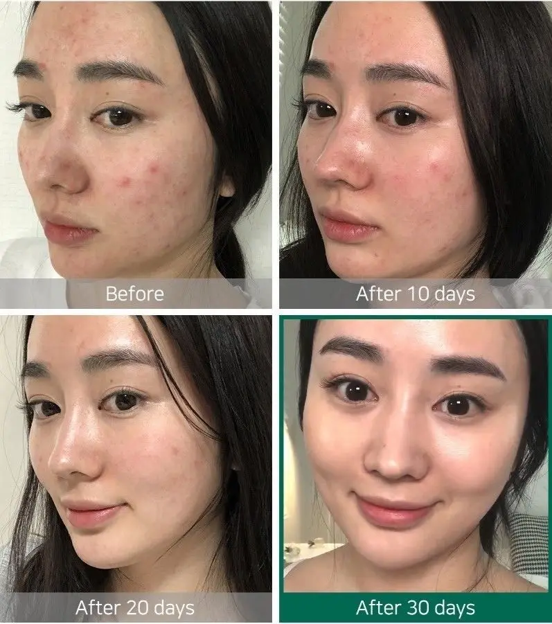 Korea Cosmetics SOME BY ME AHA BHA PHA 30 дней чудо тонер 150 мл Тоник для лица Dead Skin Pores Blackhead лечение