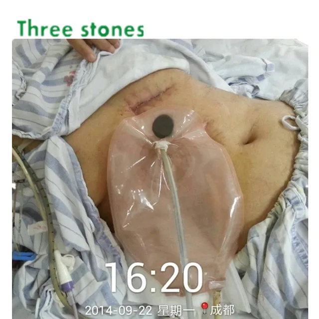 One Piece Open Colostomy Ileostomy Bag Ostomy Drainable Pouch For One Piece Open Colostomy Ileostomy Bag Ostomy Drainable Pouch For Stoma Surgery Hydrocolloid Chassis Barrier