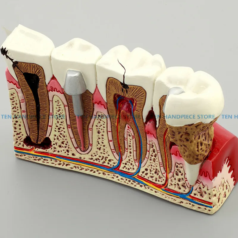 Хорошее качество кариеса зубов модель Стоматолог пациента Связь Анатомия Модель Стоматология Богатые детали учебных пособий оборудования