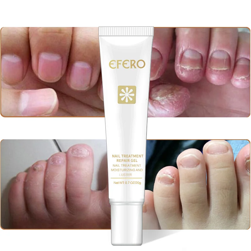 

Efero Toe Nail Fungus Removal Gel Nails Repair Essence Fungal Nail Treatment Whitening Anti Infection Feet Care Essence TSLM1