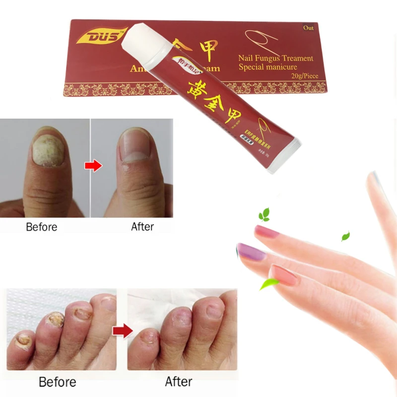 DUS, китайская медицина, крем для лечения грибка ногтей, онихомикоз, против грибковой инфекции ногтей, борется с бактериями, естественная мазь