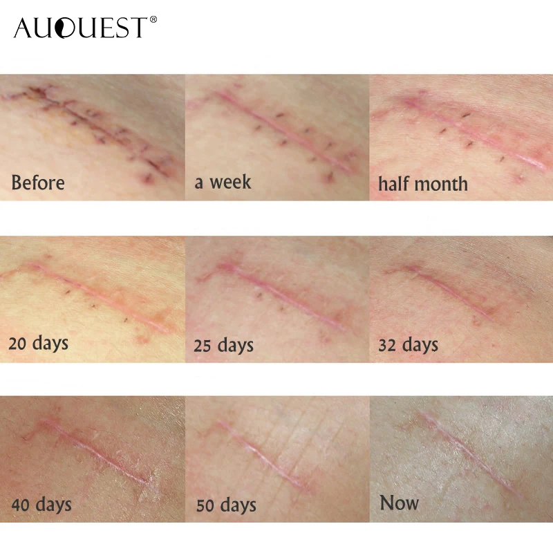 AuQuest лечение акне и удаление шрамов гель китайская медицина мазь от растяжек пигментация Conrrector уход за кожей 30 г
