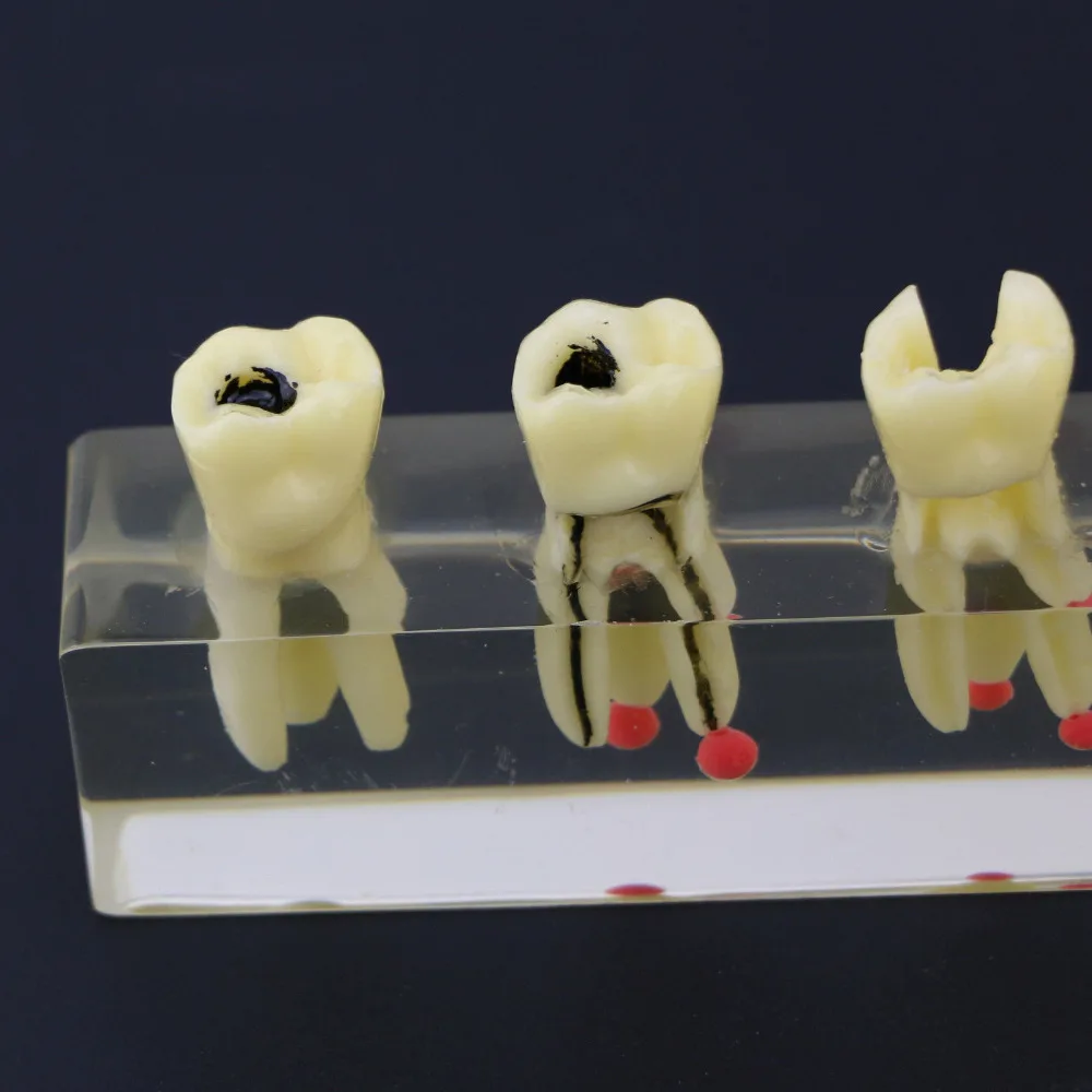 Стоматологическое Эндодонтическое лечение демонстрационная модель 4012 Исследование Обучение модель зубов