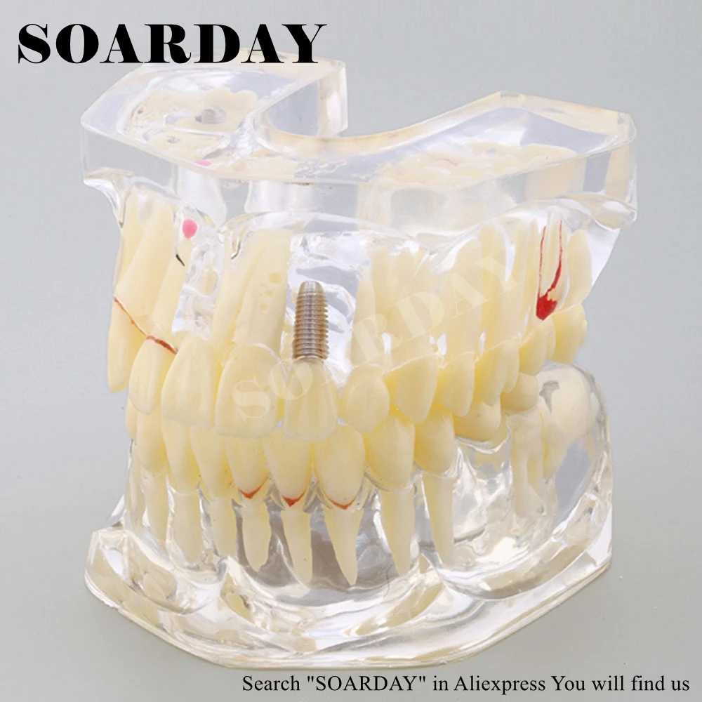 2 times Dental Pathological Model (4)