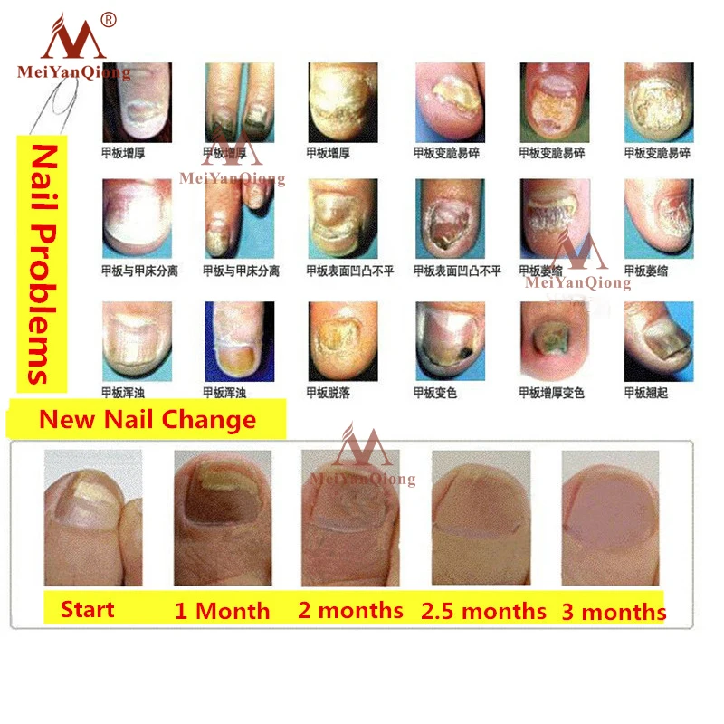 MeiYanQiong Herbal Nail Fungus Treatment Nail Care Tools Repair Skin Care Cream Remedy For Nail Foot Fungus Toe Cuticle Oil