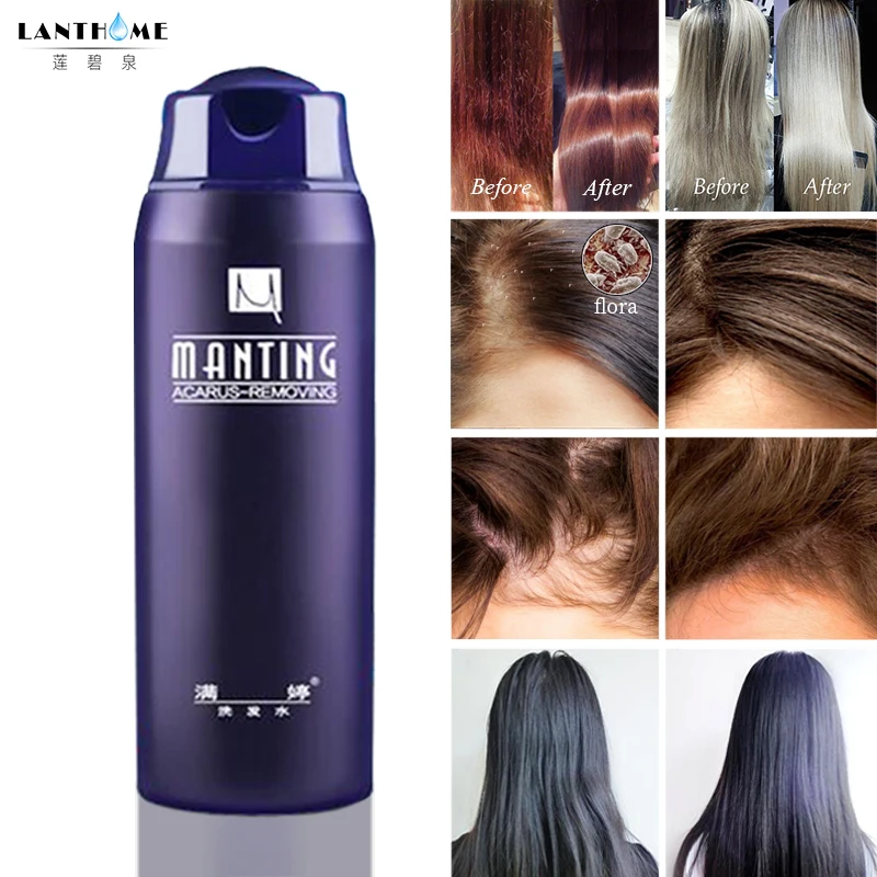 

1pc New ManTing Professional Shampoo divide mite suppression mite itching Suitable for all hair types Anti-Dandruff Anti-Itching