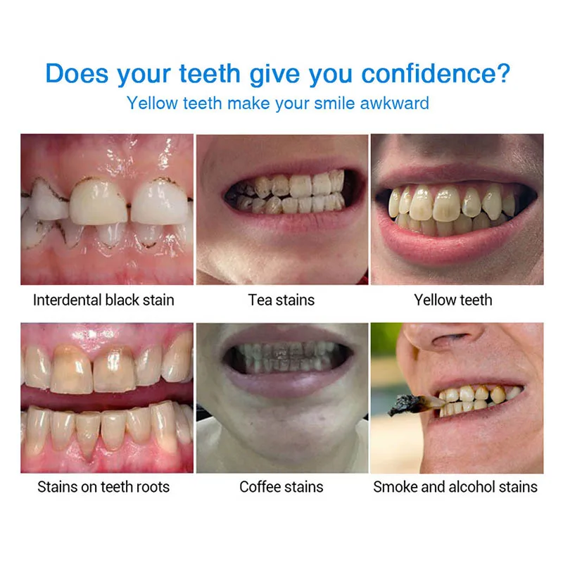 Hot Tooth Brightening Pen Teeth Whitening Tools Perfect Smile Teeth Dent Repair Wyt77 Teeth Whitening Aliexpress