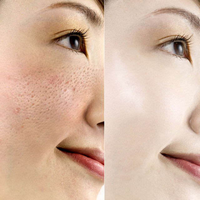 ROREC Collagen Shrink Pores Anti-Acne Hyaluronic Acid Moisturizing Face Serum Anti Aging Anti Wrinkle White Rice Skin Care Cream