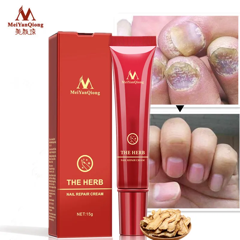 hot MeiyanQiong Nail Care Herbal Nail Repair Cream Anti Fungal Nail Chinese Herbal Toe Nail