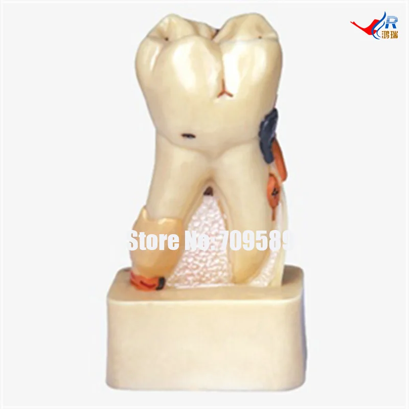

Dissected Model of Dental Disease, Dental Care Model
