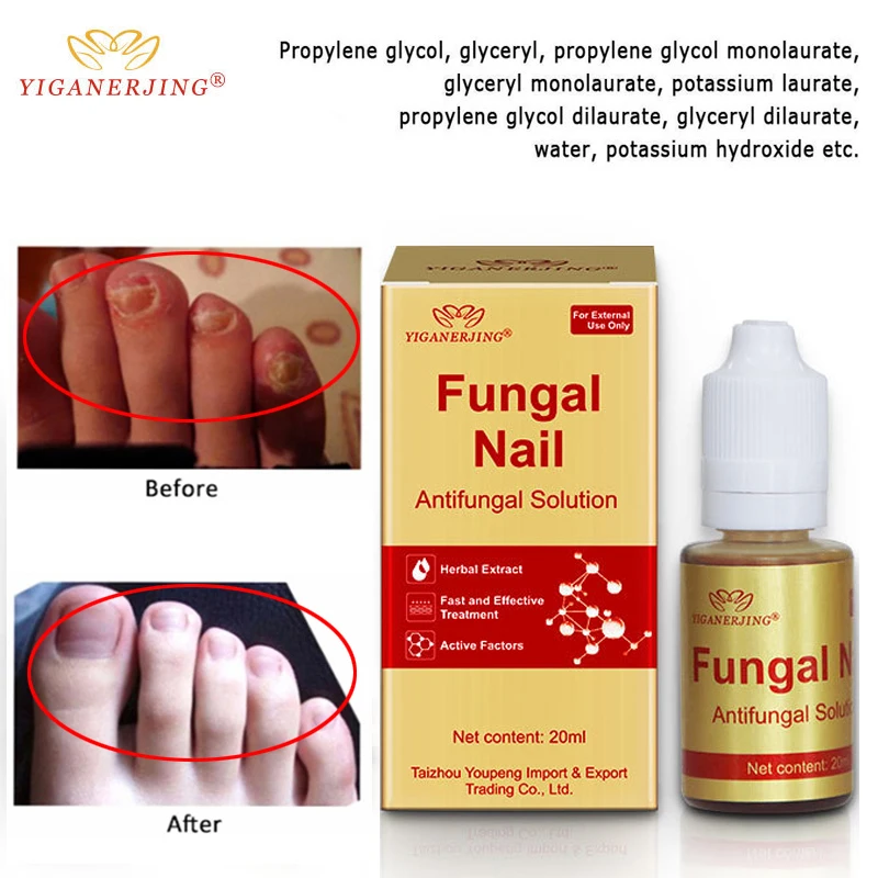 Эффективное Лечение грибка для ногтей, экстракт онихомикоза, Paronychia, убивает 99.9% бактерий и грибка, анти грибковый крем для ногтей