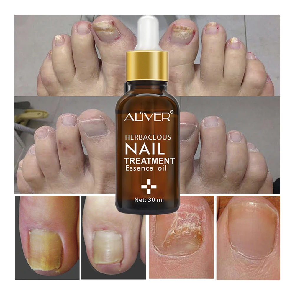 Nail Protector Skin Care Cream Nail Fungus Treatment Herb Nails Repair Cream Onychomycosis Paronychia Anti Fungal Nail Care