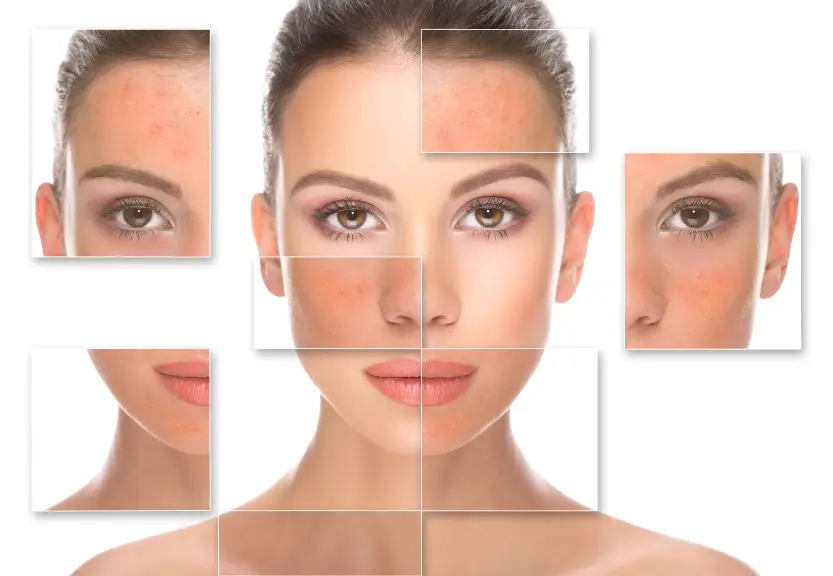

SALICYLIC Acid Chemical Peel 5% 10% 20% 30% Acne Scars Black heads spots 1oz free shipping