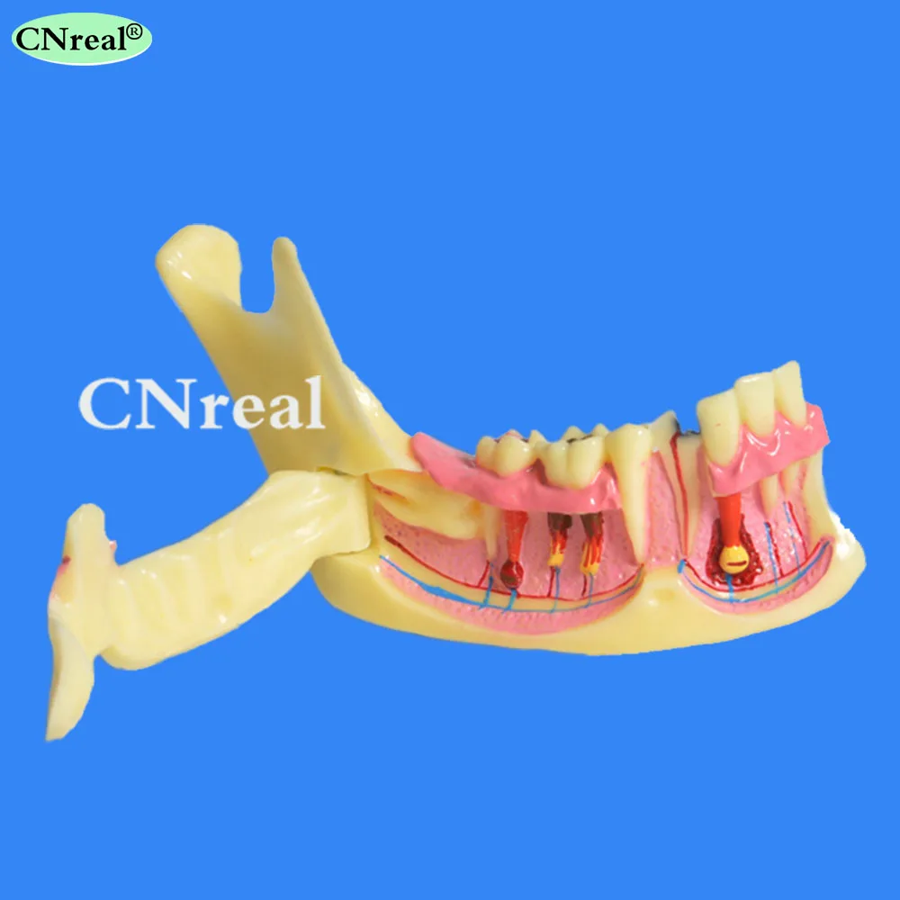 1 шт. мандибль зубы Патологии Модель для стоматологического обучения смолы