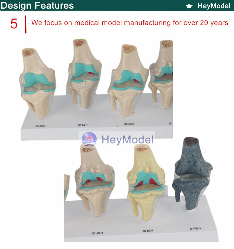 Heymodel коленного сустава поражения модель коленного сустава гемофилия травмы колена спектакли скелетных скелет