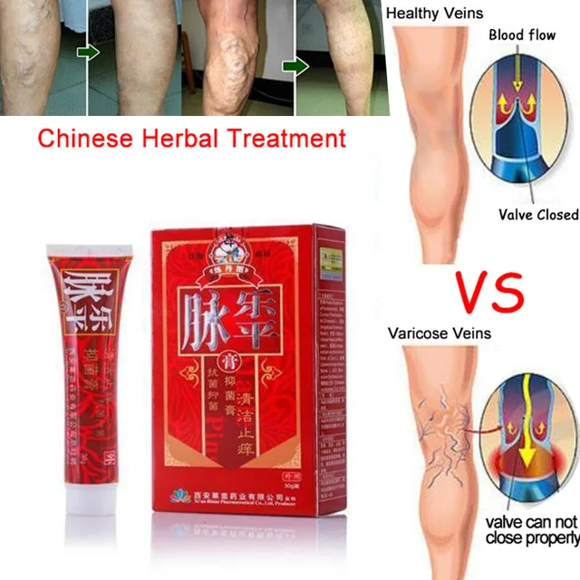 best varicose vein cream best varicose vein cream