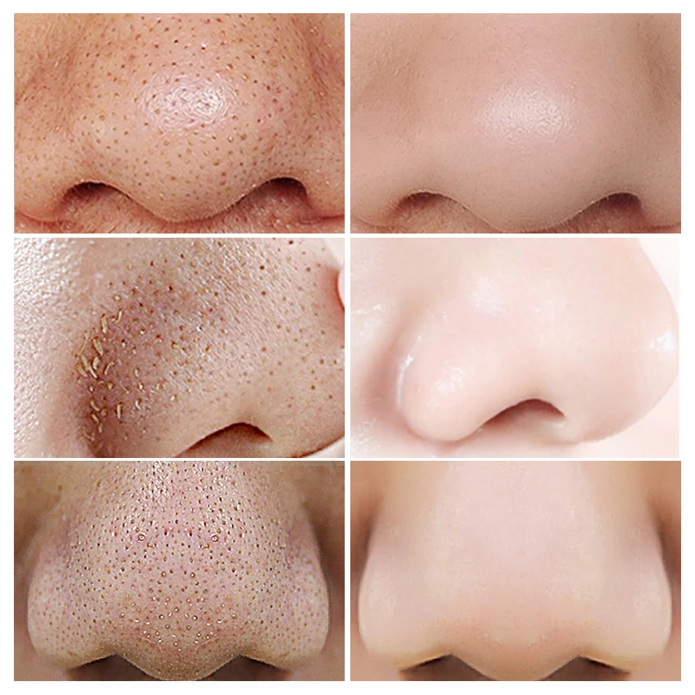 Lanbena Face Serum Skin Care Beauty Blackhead Remover Deep Cleaning Shrinking Pore Purifying Acne Treatment Essence Smoothing