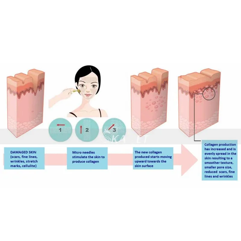 Лидер продаж DRS540 0,2/0,25/0,3 мм Microneddles Дерма ролик дермабразия лица дермароллер, соответствует стандартам ЕС