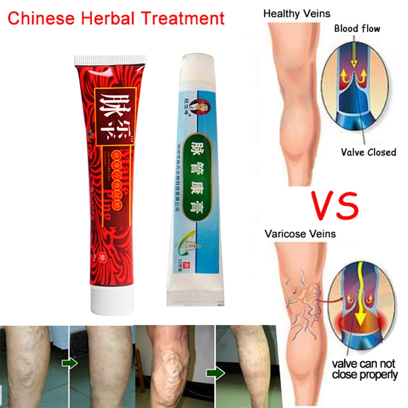 Боли вена нога мазь. Варикоз вен на ногах для МАЗ. Венозное расширение вен мазь.