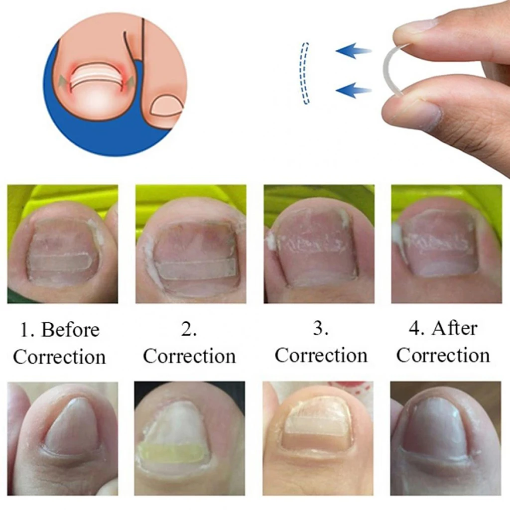 

10Pcs Safety Ingrown Toenail Straightening Clip Curved Brace Toenails Imported Fibreboard Correction Tool TSLM2