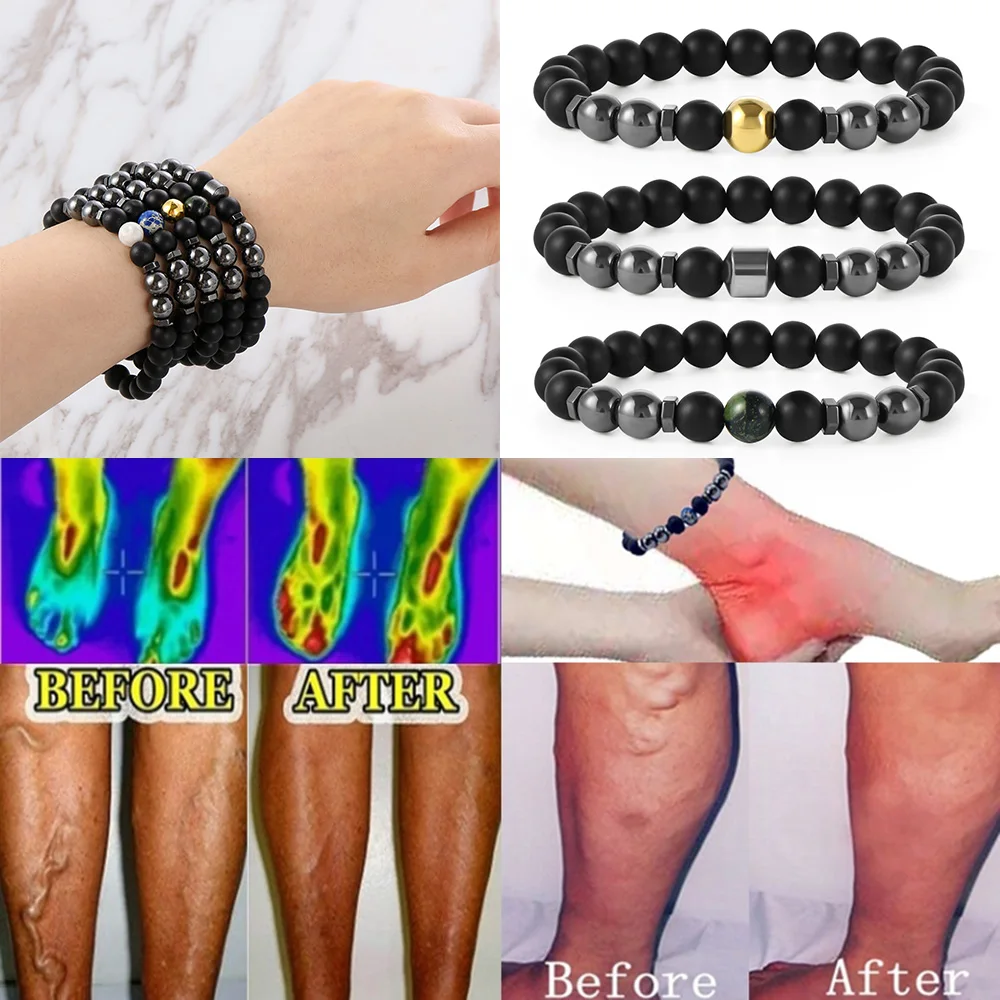 

Magnetic Anklet Bracelet Varicose Veins Vasculitis Pain Relief For Lose Weight Stretch Bangle Weight loss Slimming Hematite Acup