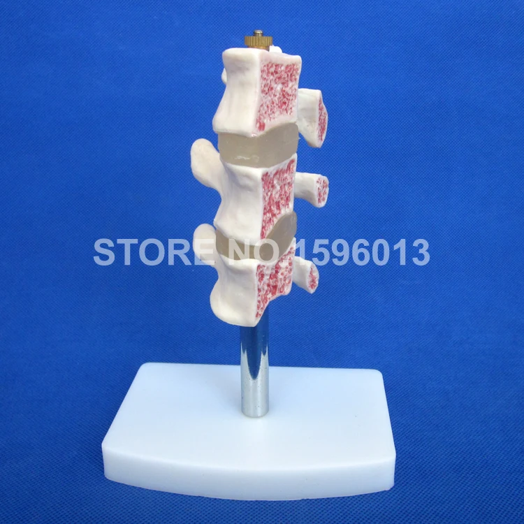 134 osteoporosis model (3)