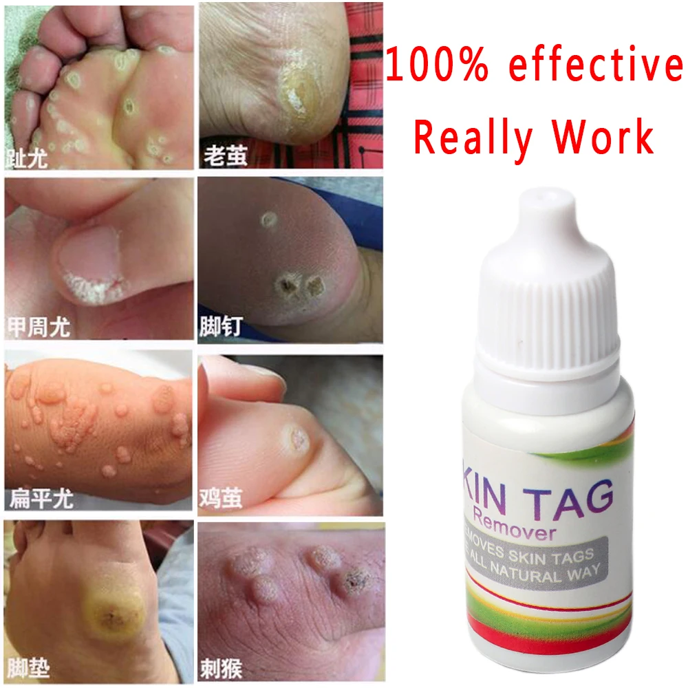 

2019 NEW Upgrade Body Warts Corn Mole Genital Wart Treatment Cream Skin Tag Remover Foot Corn Removal Plantar Warts 10ML