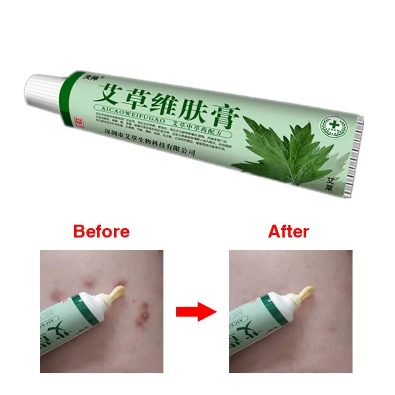 

Powerful Psoriasis Dermatitis Eczema Pruritus Ointment Cream anti acne treatment cream 15g