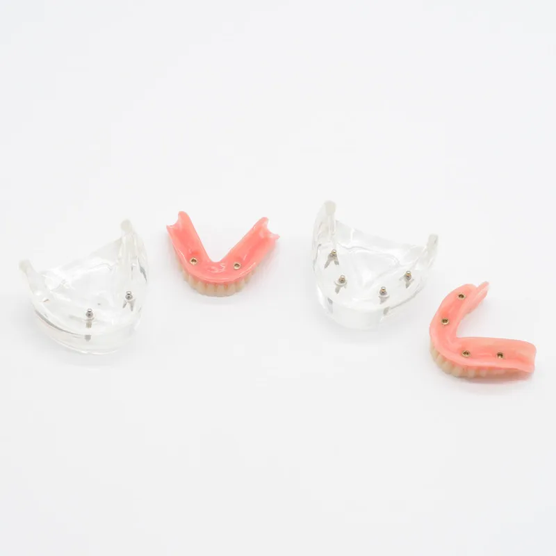 Дантист Обучение Модель нижней челюсти с 2/4 имплантатов восстановление для стоматологической клинике