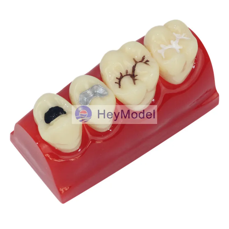 Heymodel зубы ямы и трещины Модель Стоматологическая dentition модель