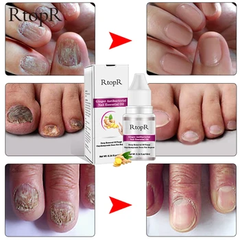 

Ginger Antibacterial Nail Treatment Onychomycosis Paronychia Anti Fungal Nail Infection Toe Nail Fungus Treatment Essential Oil