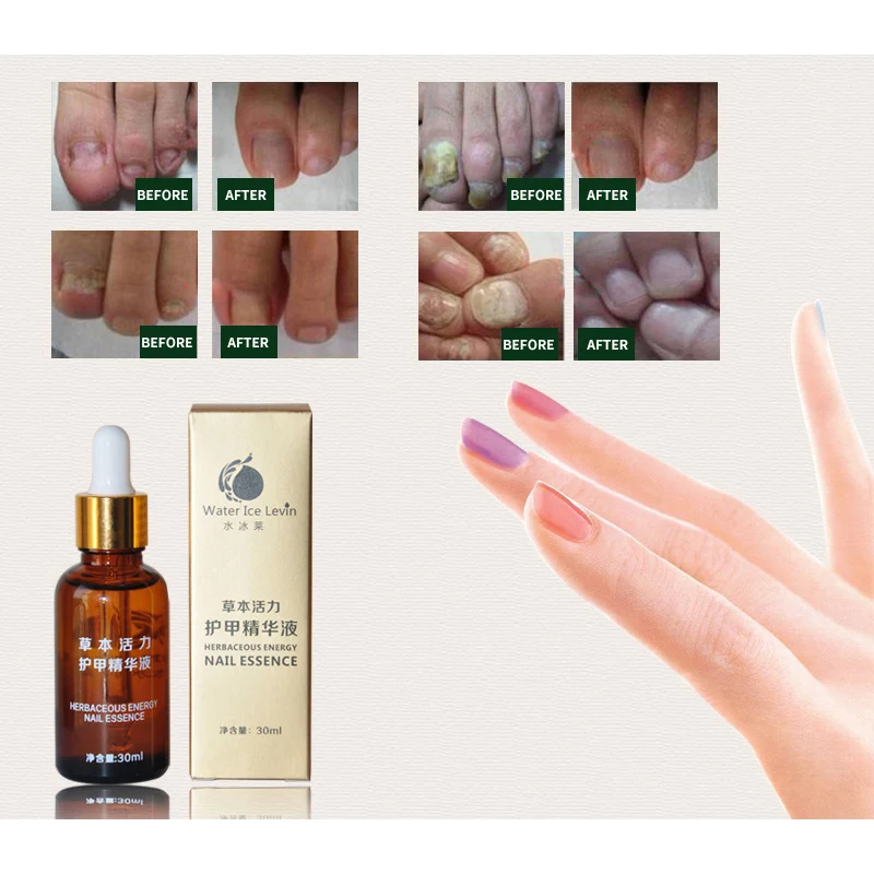 

Powerful Fungal Nail Treatment Essence Oil 30ml Feet Care Nail Polish Tools Nail Gel Armor Essence Toe Nail Fungus Removal