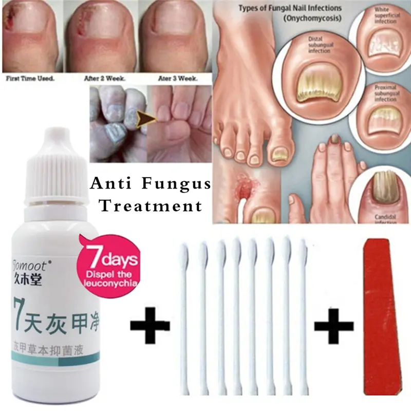 10ml Nail Fungus Treatment Anti Fungal Infection with Cotton Swabs Toe Finger Onychomycosis