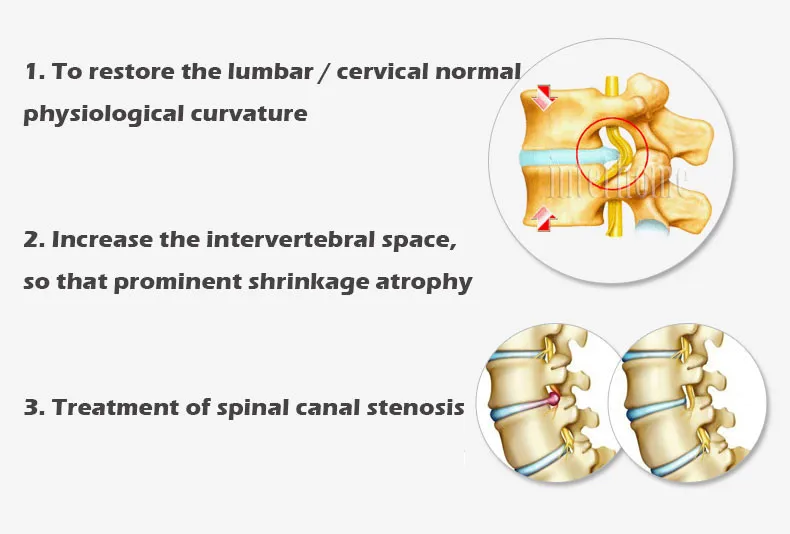 Запатентованная эффективная Тяговая кровать для шейного спондилеза поясничная боль терапия оборудование для растяжения тела лечение низкой спины Lumbago