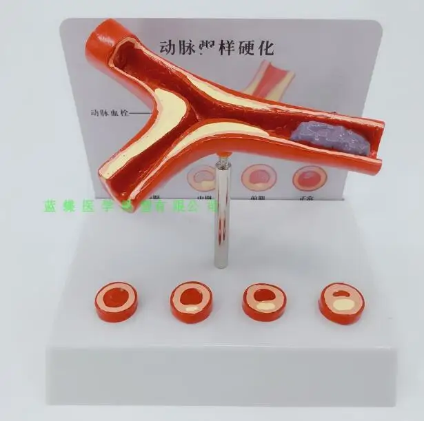 Human arterial arterial infarction model blood clot/formation model blood vessel model with atherosclerotic infarction