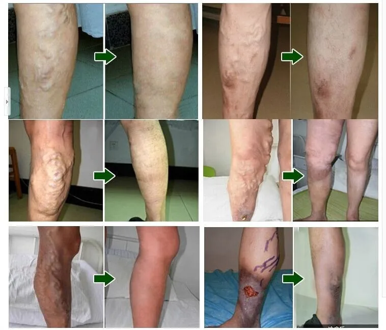 1-2 Упаковка варикозный медицинский препарат против варикозного расшрения вен крем лечение против ног васкулит флебит травяной продукт массажер для ног