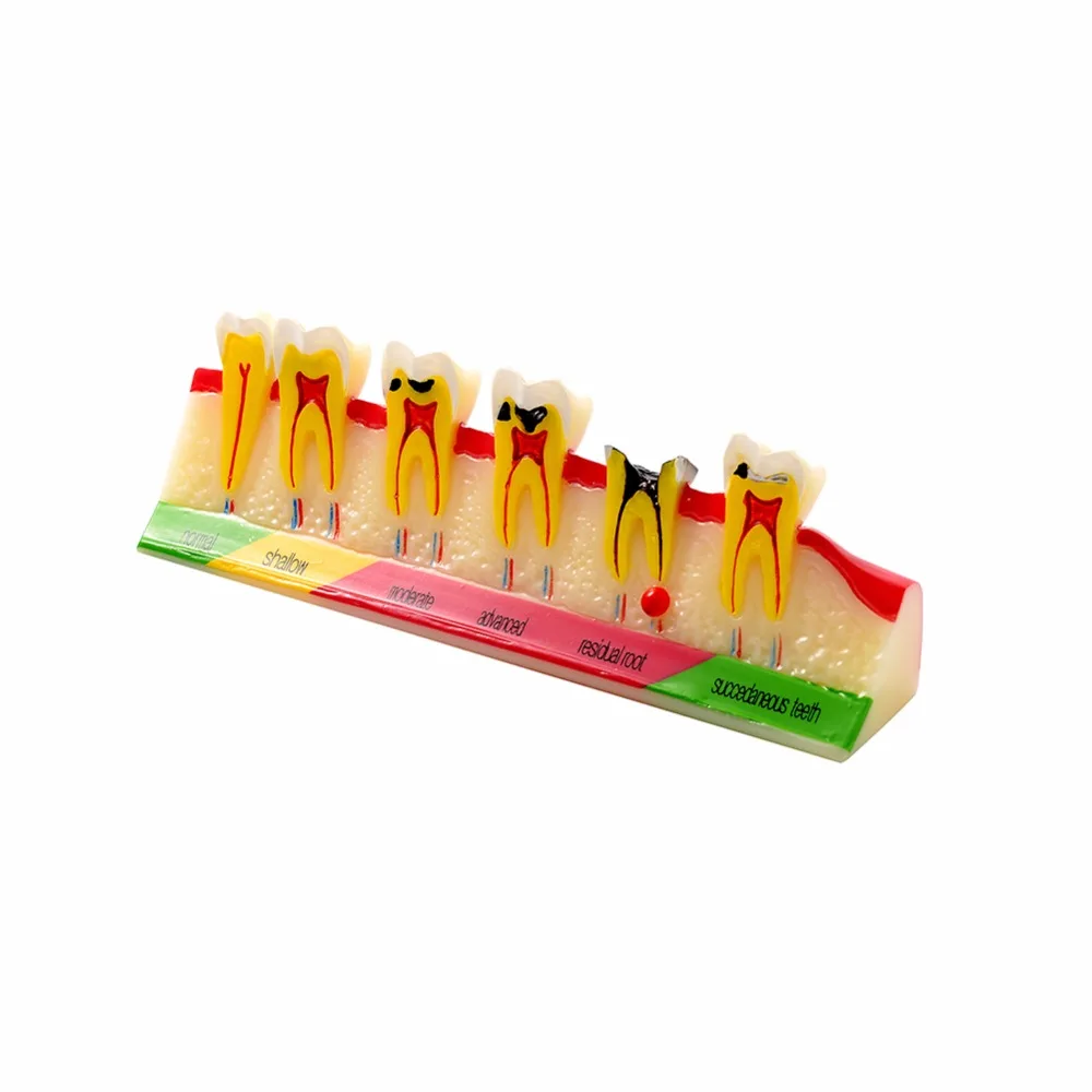 

DENTAL MODEL TEETH EASYINSMILE DENTAL DISEASE EDUCATION MODEL