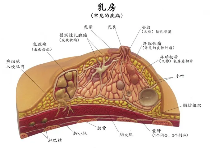 Заболеваний молочной железы груди Модель анатомии человеческого тела Модель анатомии человека патологическая Модель груди медицинской болезни и рака анатомия