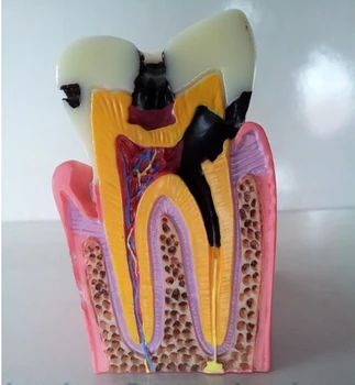 

2017 Denture Teeth Anatomical Model Caries Comparison Model,Tooth Decay Model,Dentist for Medical Science Teaching Dental Supply
