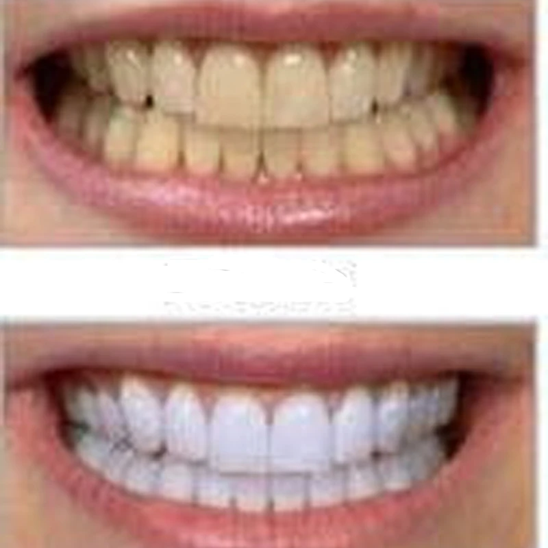 Biggest promotion 1pcs HIGH STRENGTH BLEACHING TEETH WHITENING TOOTH WHITENER GEL PEN STRONG Dental