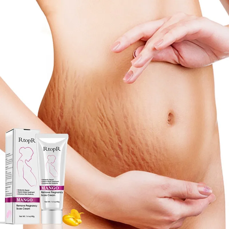 

Effective!Mango Remove Pregnancy Scars Cream Natural Mild Non-irritating Body Cream