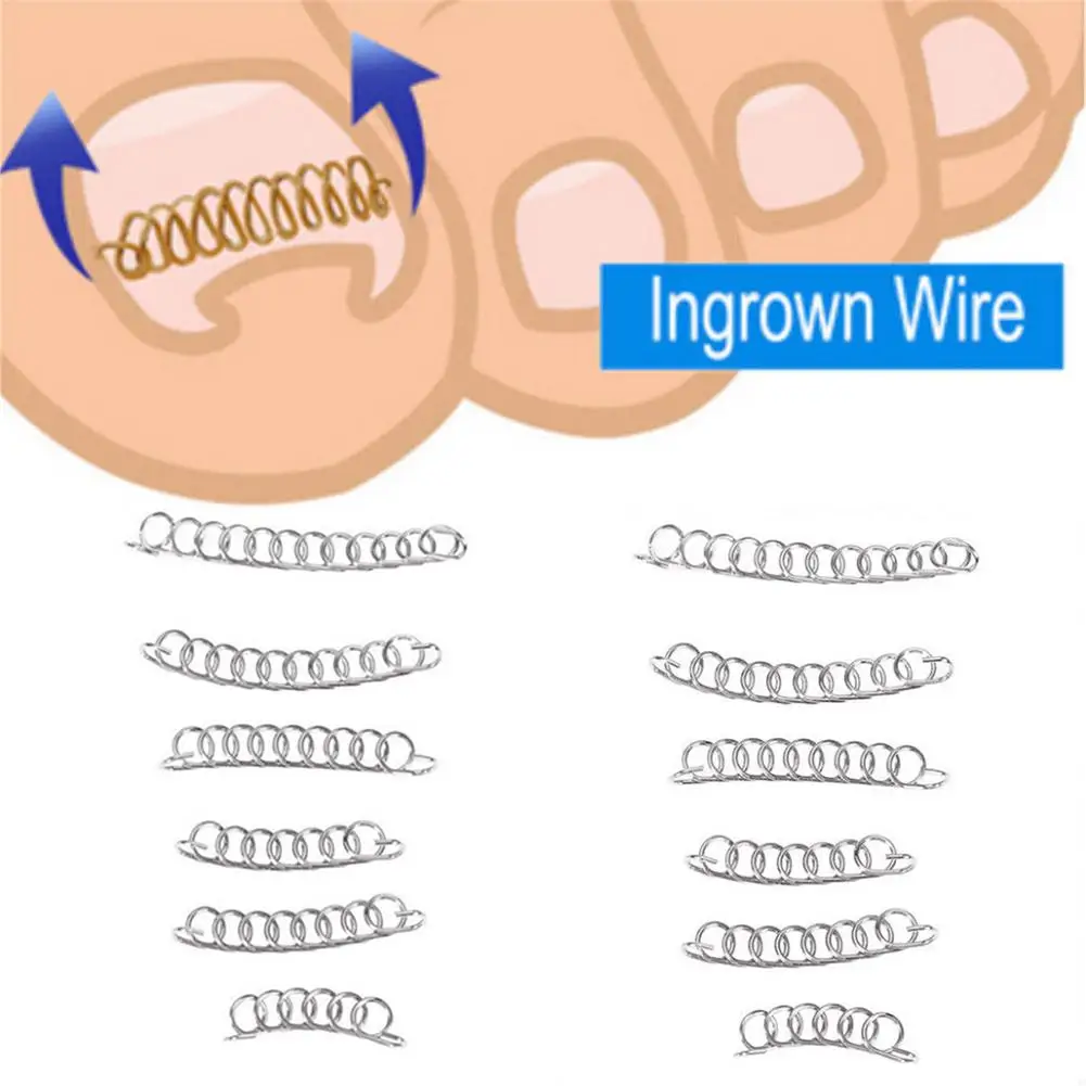 BellyLady 12 шт./кор. вросший носок ногтей корректирующий педикюр провода фиксатор Paronychia Восстановления Инструмент