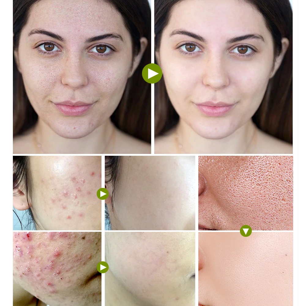 VIBRANT GLAMOUR Tea Tree Acne Face Cream Treatment Acne Scar Shrink Pores Oil Control Facial Skin Care Whitening Moisturizing