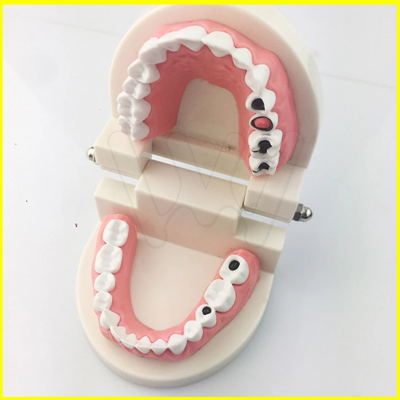 1x-EASYINSMILE-Dental-Caries-Tooth-Study-Model-Typodont-_57