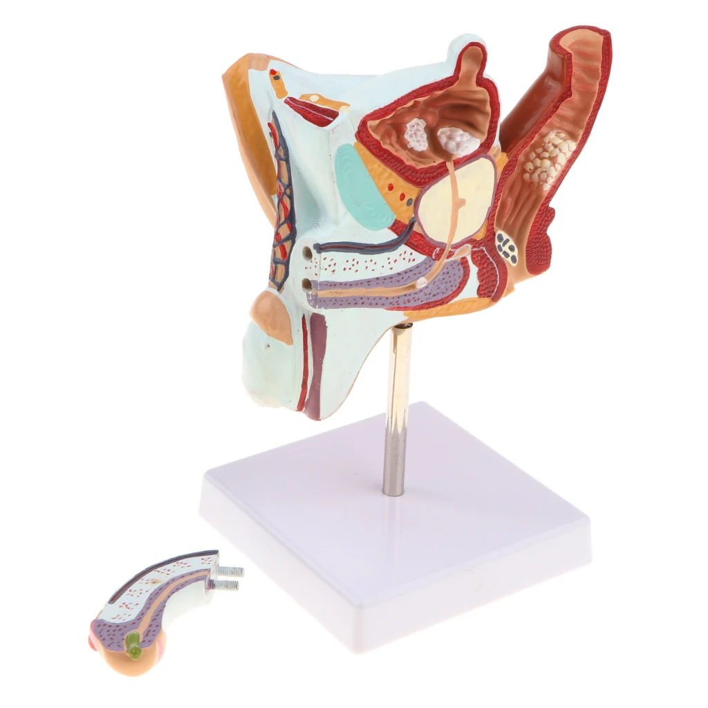 1:1 Human Male Reproduction Urinary System Pathlology Model Gonorrhea Ureteral Calculus Display Medical Study Lab Supplies