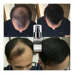 LANBENA средство для роста волос спрей быстрое мощное средство для роста волос продукты эфирное масло лечение предупреждающий потерю волос 65